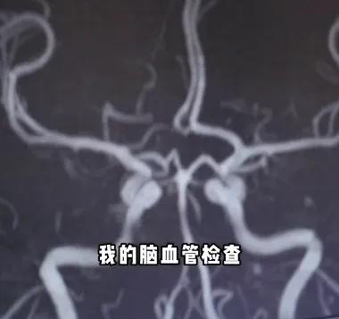 45歲三甲醫(yī)院腦梗專(zhuān)家自己腦梗了
