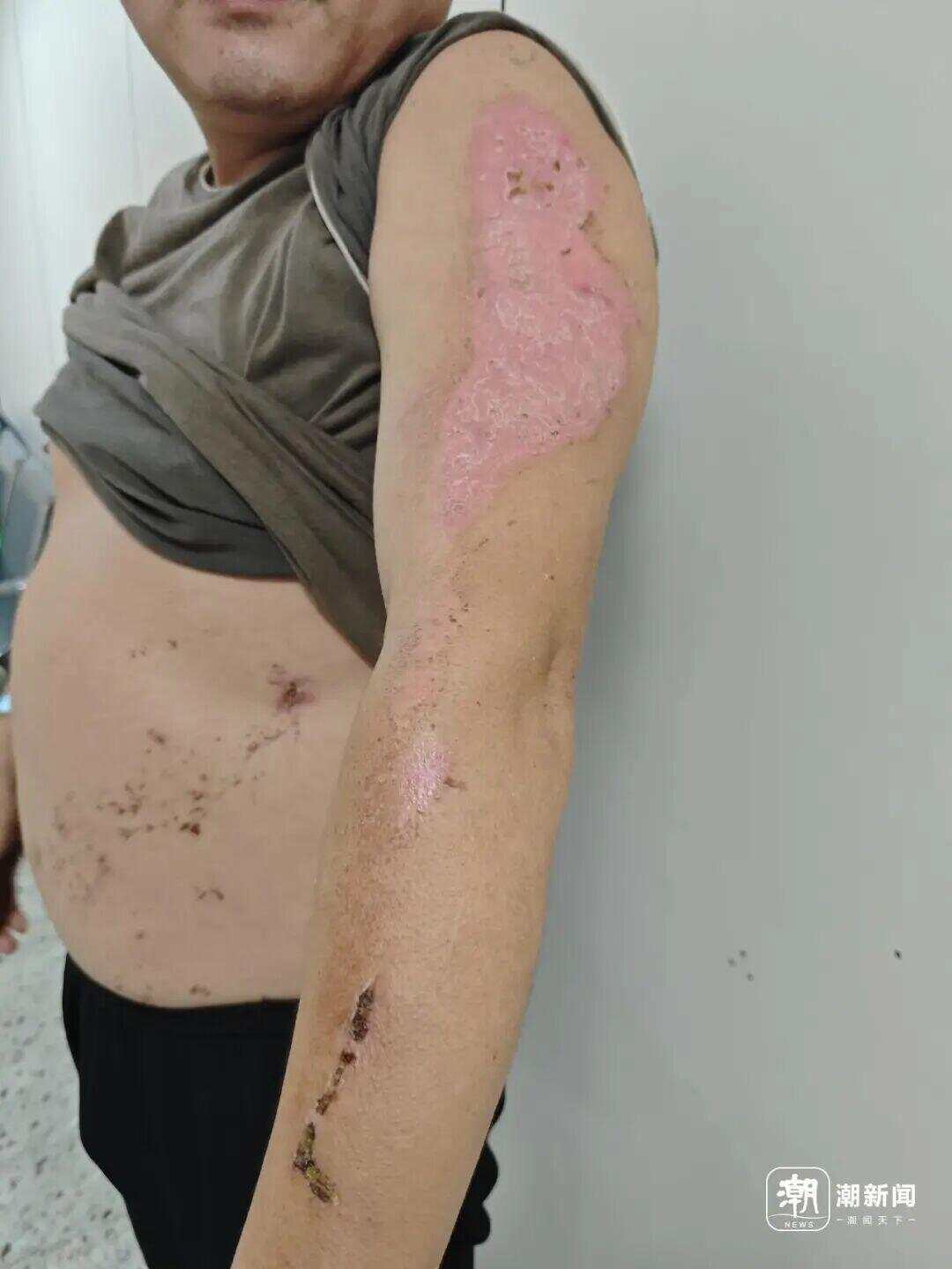 丈夫兩次沖進火場救妻雙雙燒傷